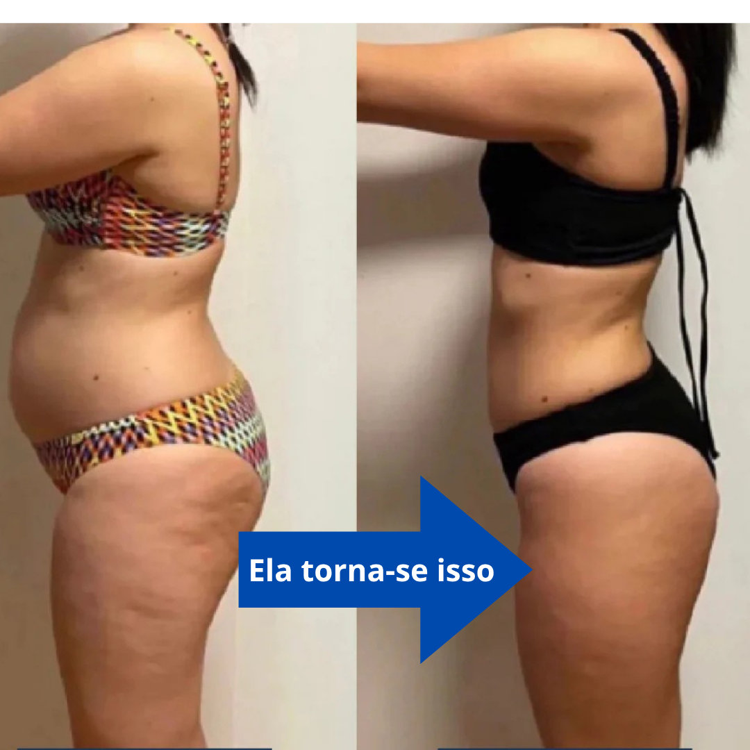 SlimTone® Pro - Dispositivo de remoção